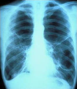 Human chest x ray showing the two lungs.